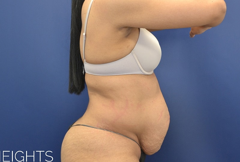 Liposuction Before & After