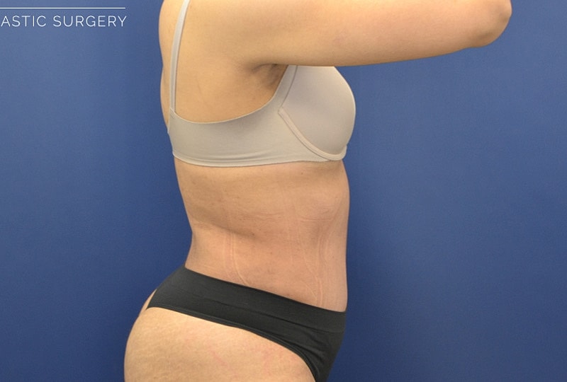 Liposuction Before & After