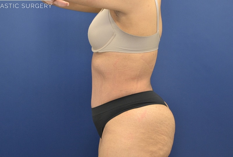 Liposuction Before & After