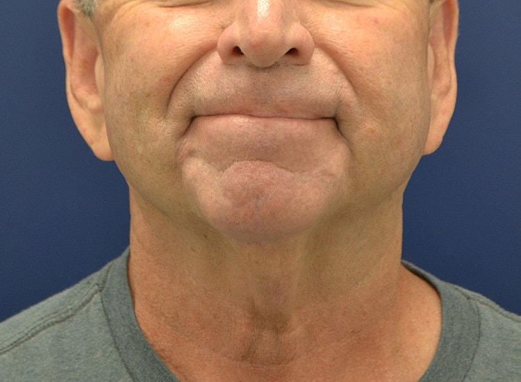 Male Neck Lift Before & After
