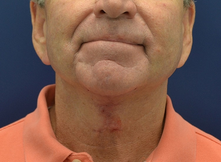 Male Neck Lift Before & After