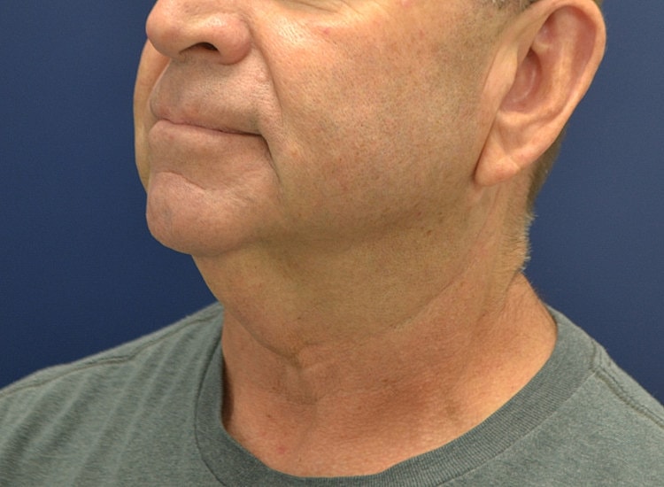 Male Neck Lift Before & After