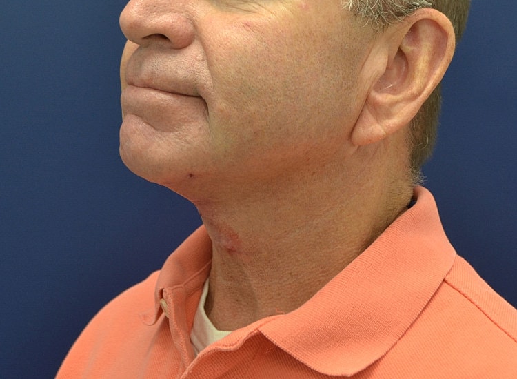 Male Neck Lift Before & After