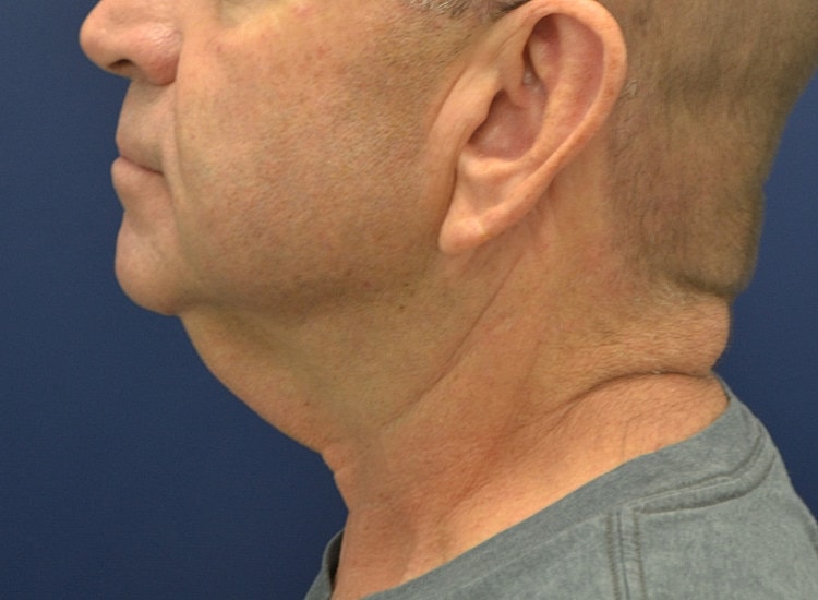 Male Neck Lift Before & After