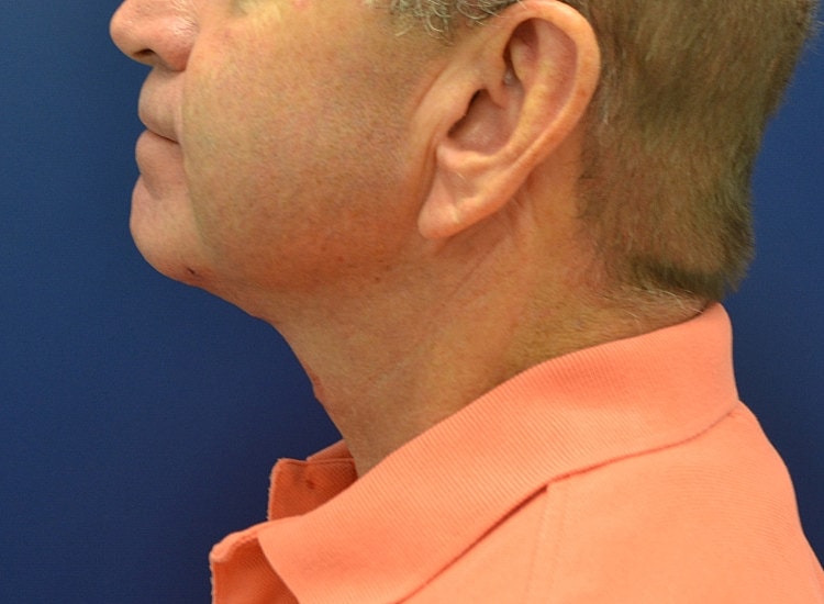 Male Neck Lift Before & After