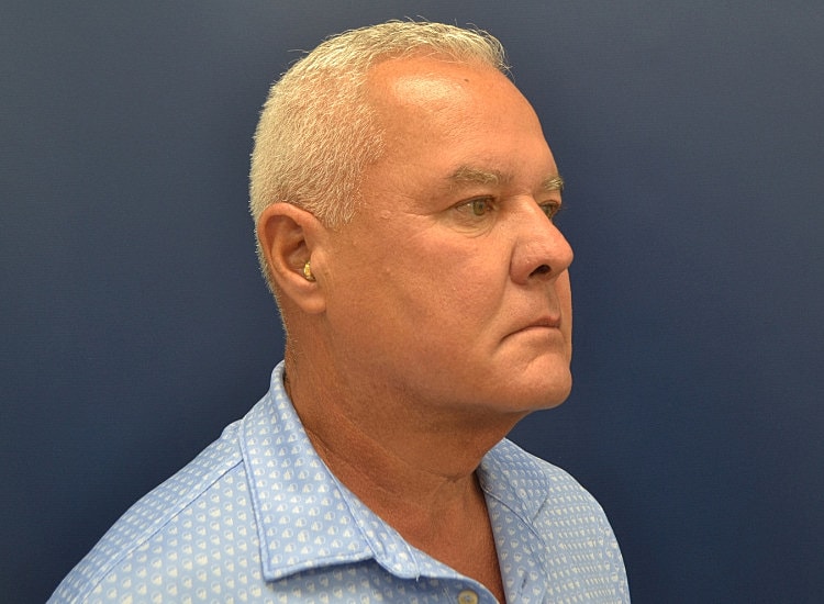 Male Neck Lift Before & After