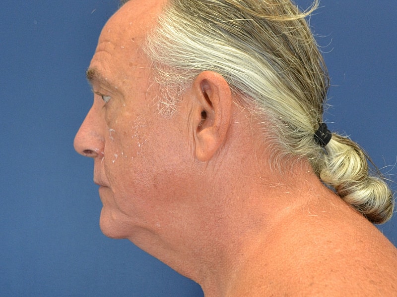 Male Neck Lift Before & After