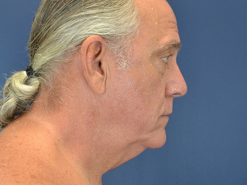 Male Neck Lift Before & After