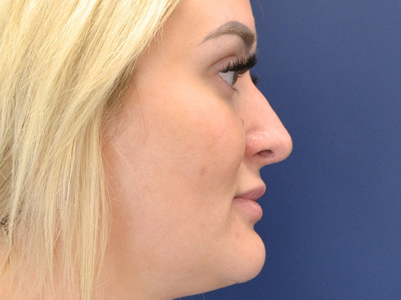 Rhinoplasty Before & After