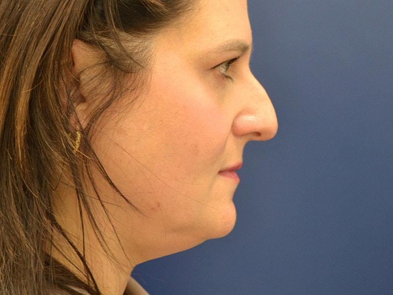 Rhinoplasty Before & After