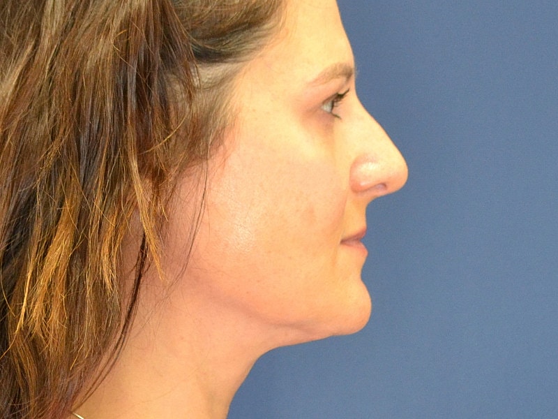 Rhinoplasty Before & After
