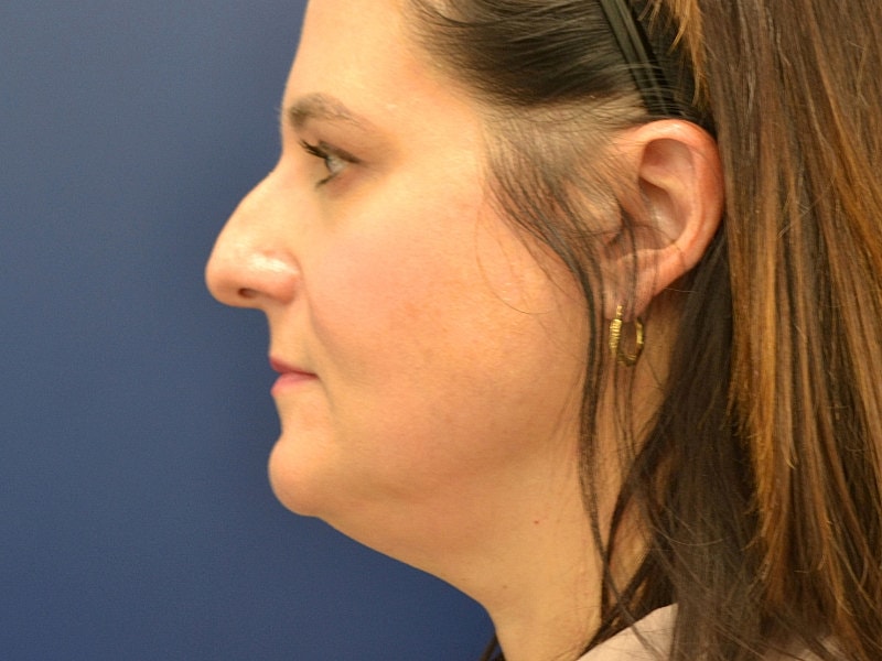 Rhinoplasty Before & After