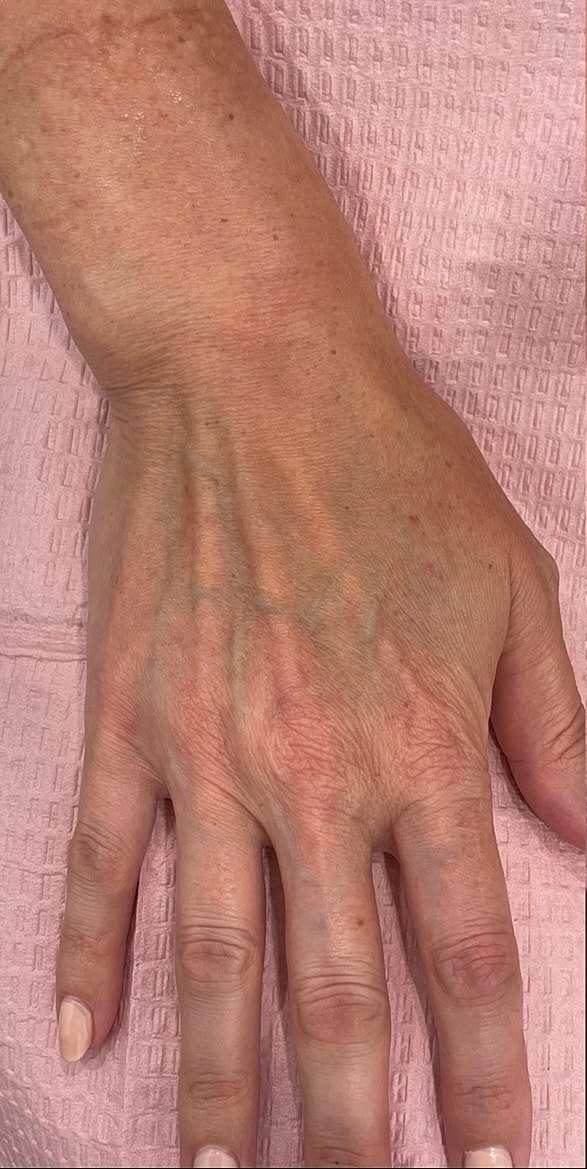 Hand Fillers Before & After