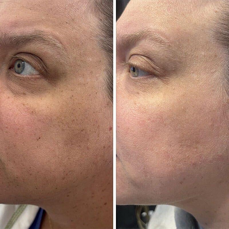 Ipl Before & After