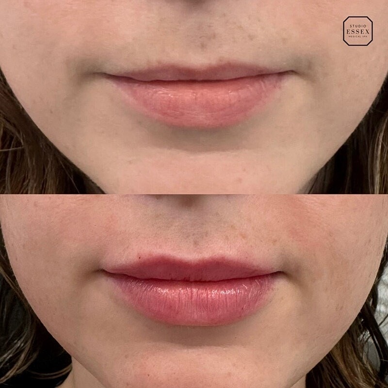Lip Filler Before & After