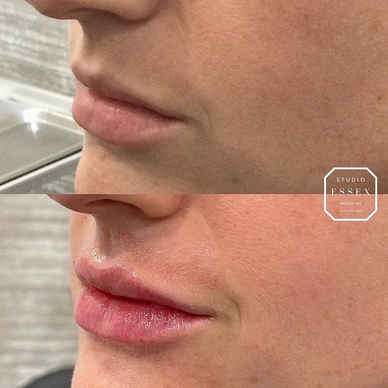 Lip Filler Before & After