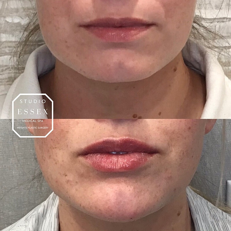 Lip Filler Before & After
