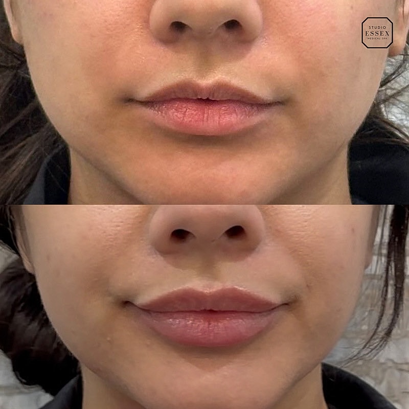 Lip Filler Before & After