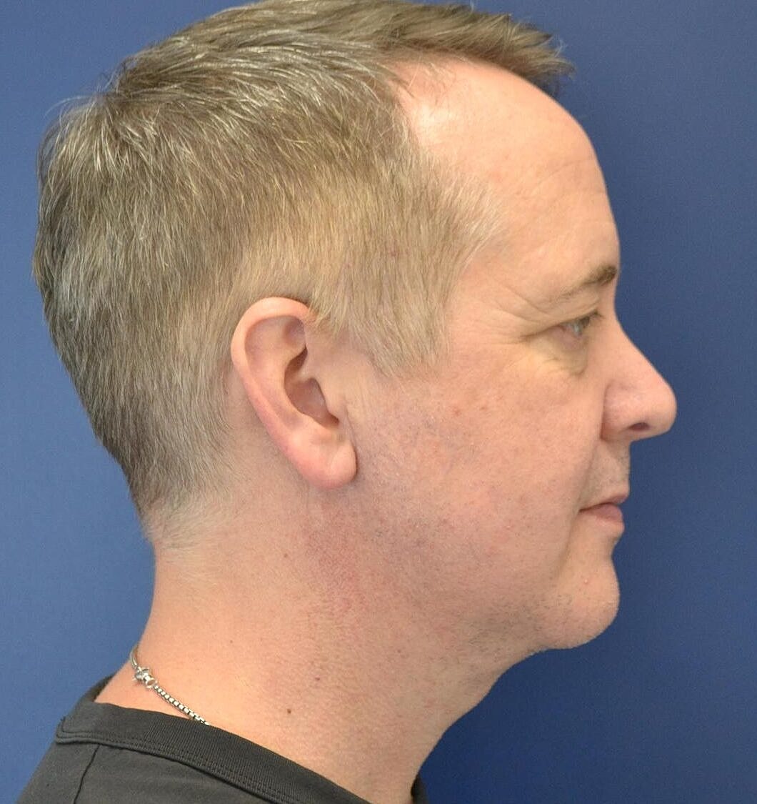 Chin Implants Before & After