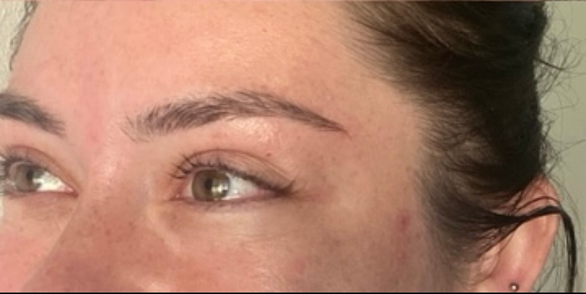 Toxin Treatments Before & After