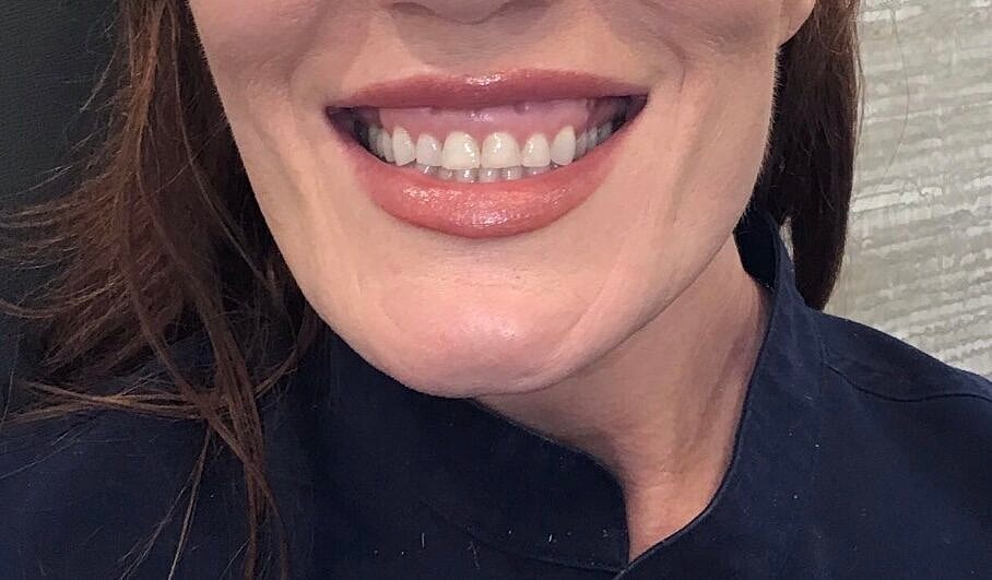 Toxin Treatments Before & After