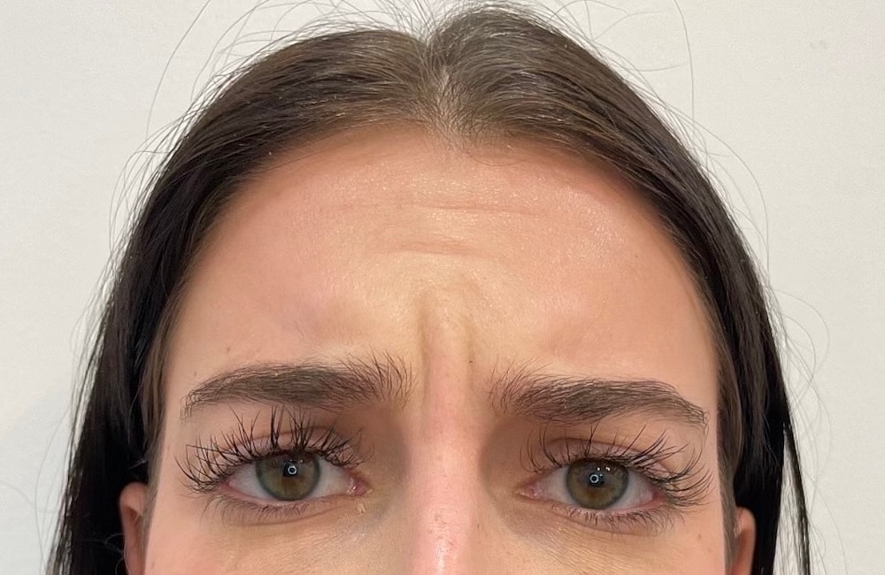 Toxin Treatments Before & After