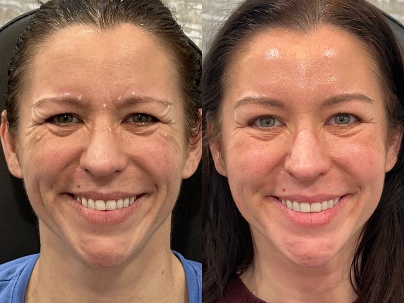 Toxin Treatments Before & After