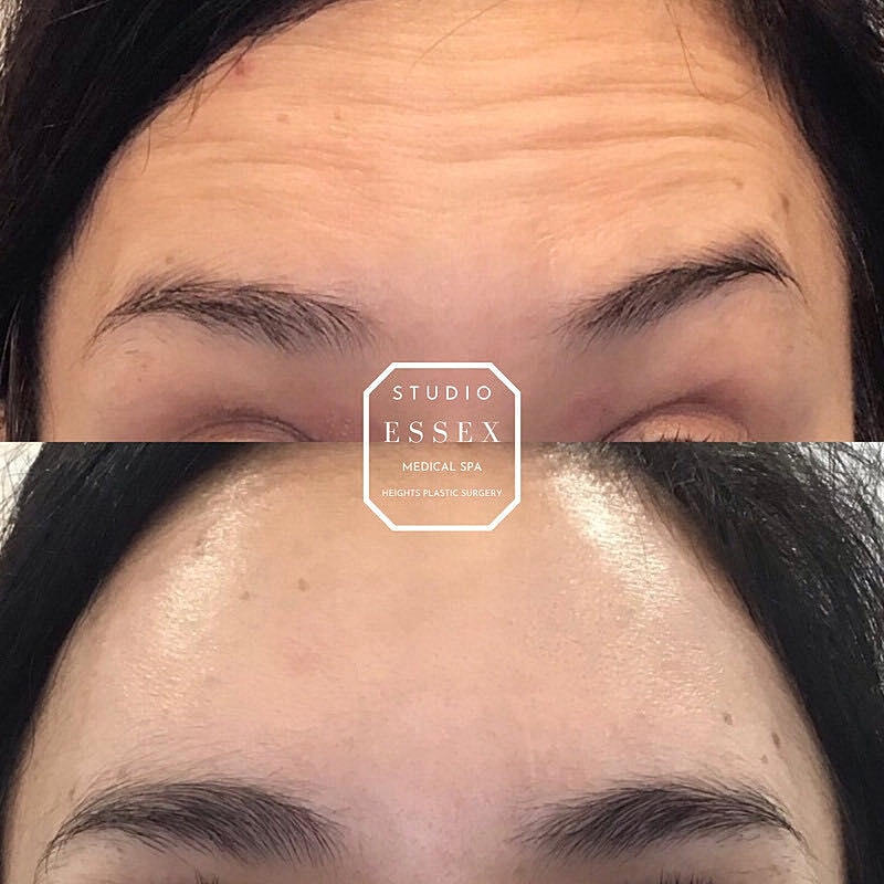 Toxin Treatments Before & After