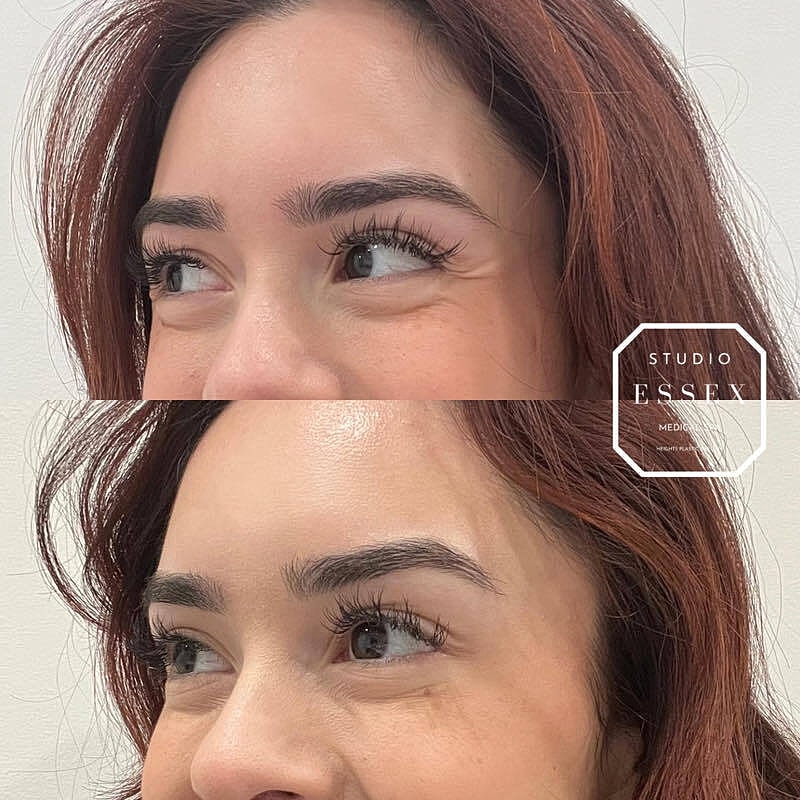 Toxin Treatments Before & After