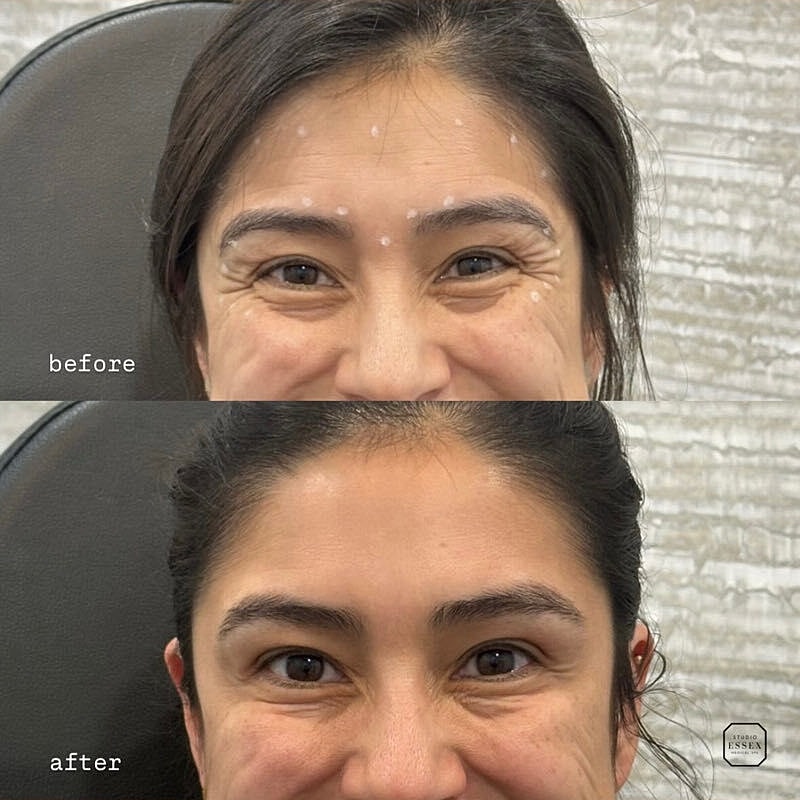 Toxin Treatments Before & After