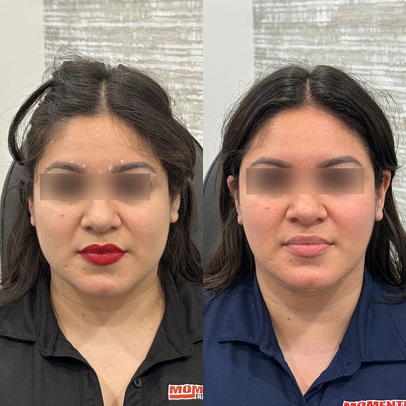 Toxin Treatments Before & After