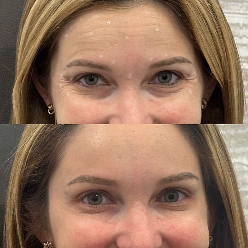 Toxin Treatments Before & After