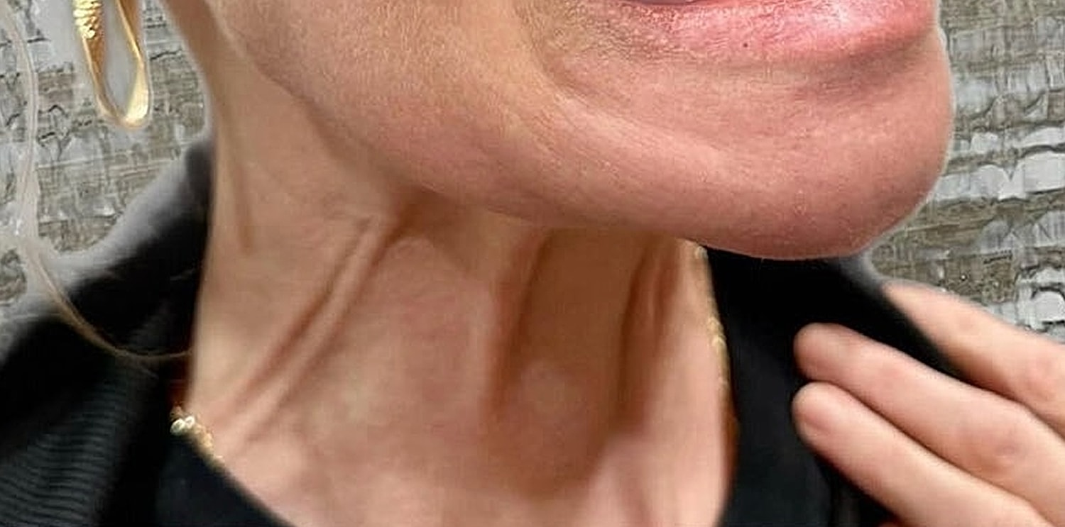 Toxin Treatments Before & After