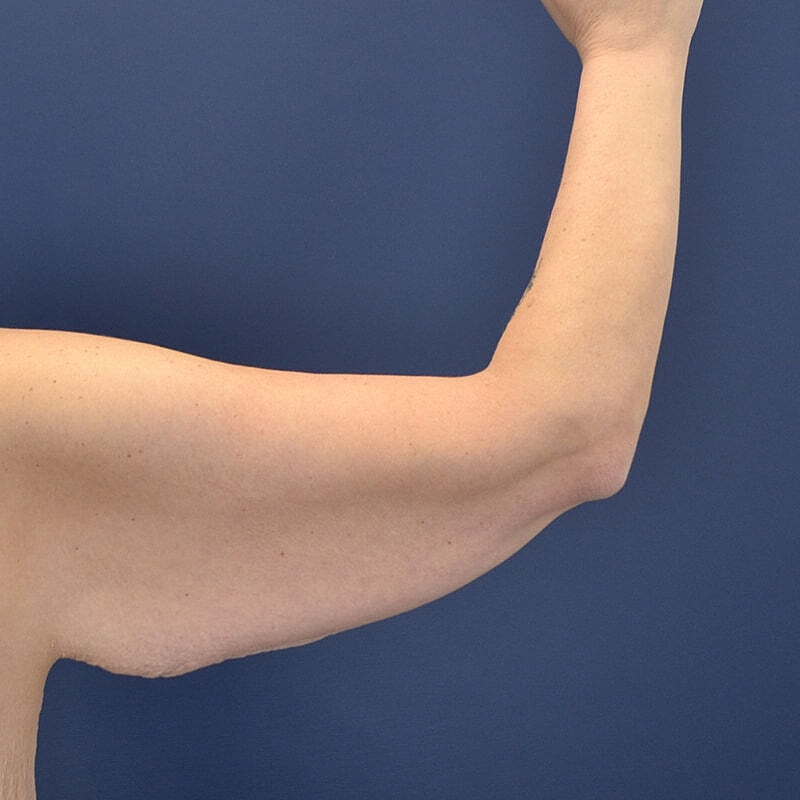Arm Lift Before & After