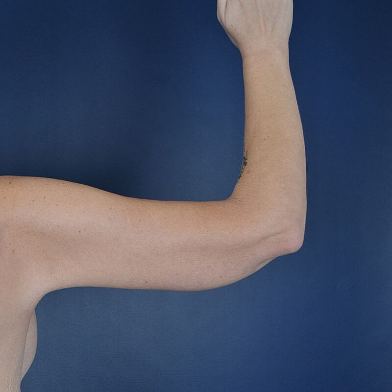 Arm Lift Before & After