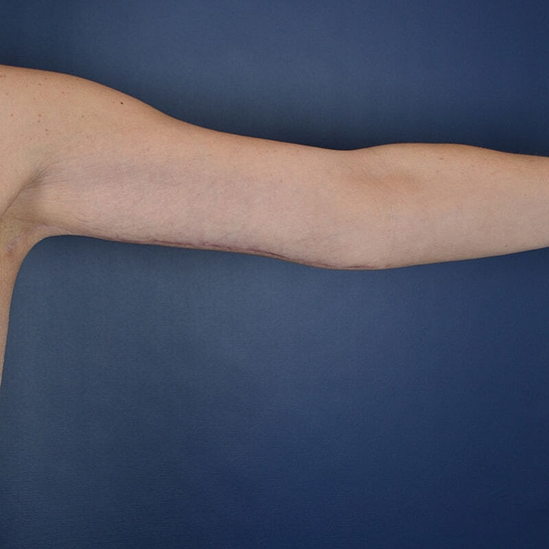 Arm Lift Before & After