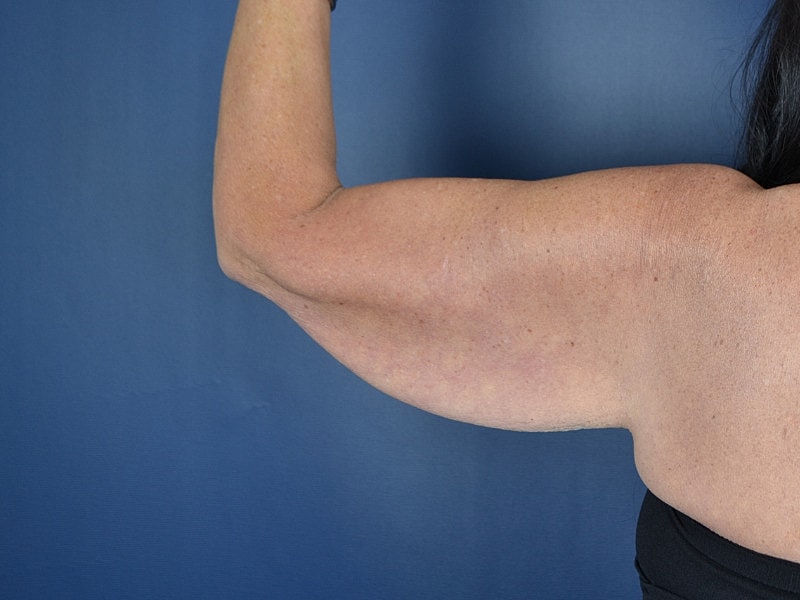 Arm Lift Before & After