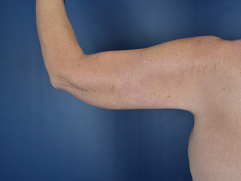 Arm Lift Before & After