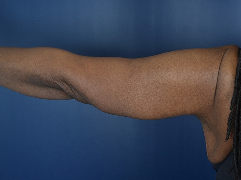 Arm Lift Before & After