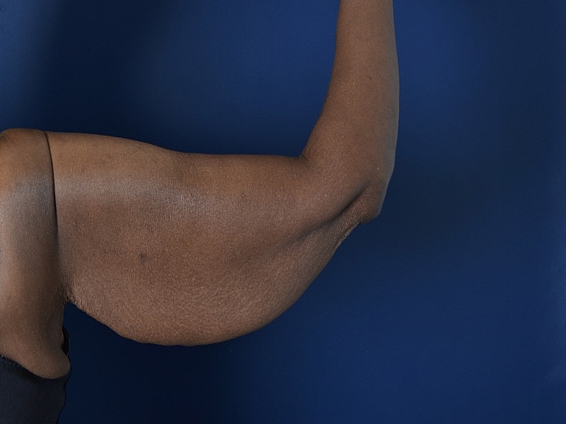 Arm Lift Before & After