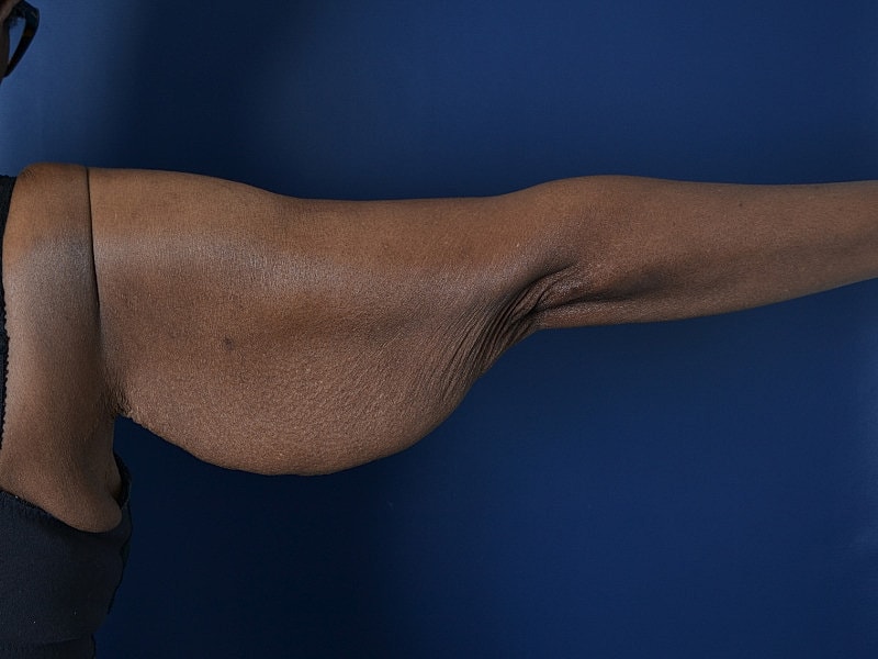 Arm Lift Before & After