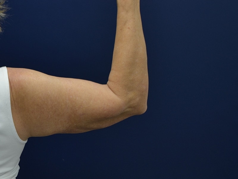 Arm Lift Before & After