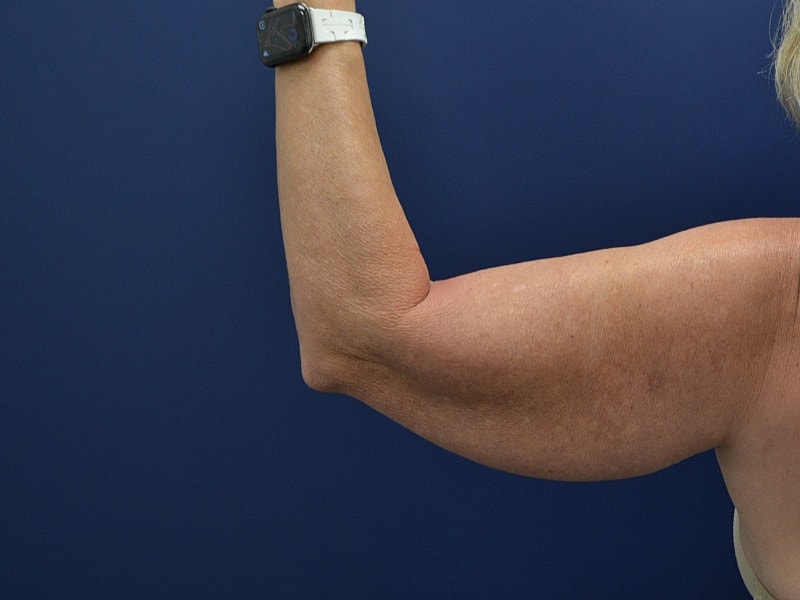 Arm Lift Before & After