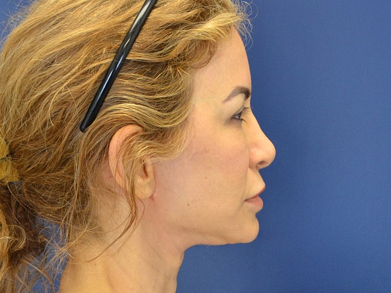 Neck Lift Before & After