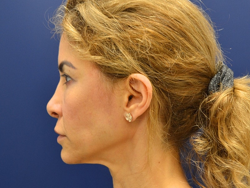 Neck Lift Before & After
