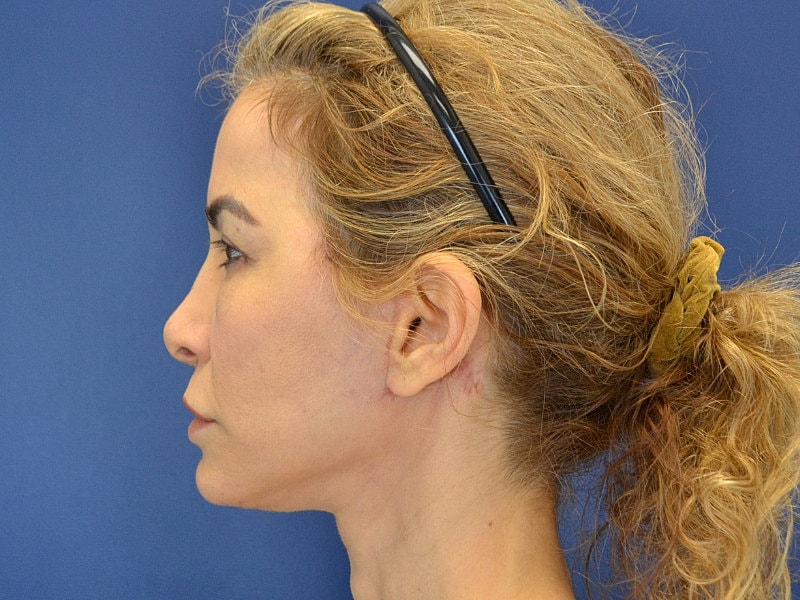 Neck Lift Before & After