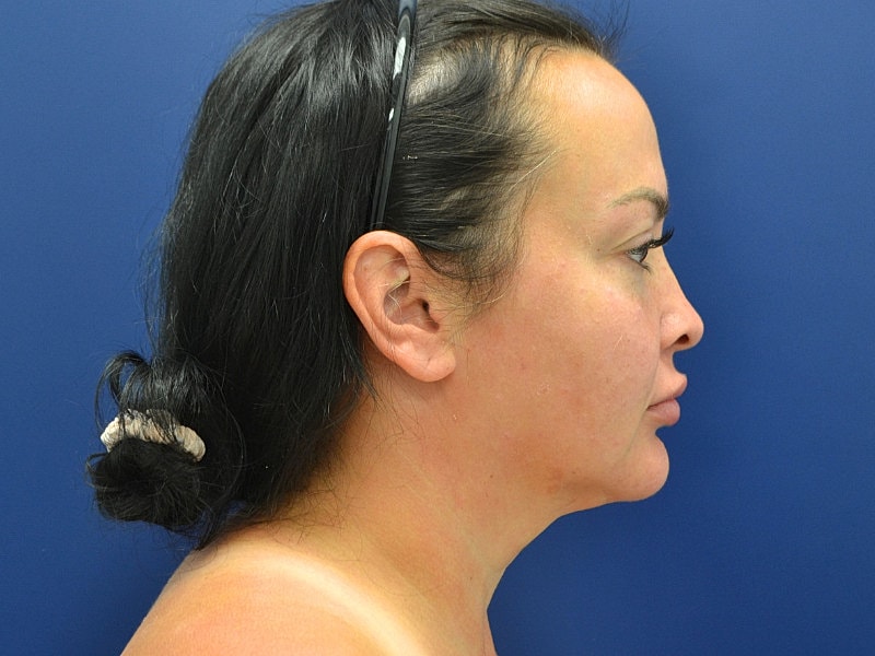 Neck Lift Before & After