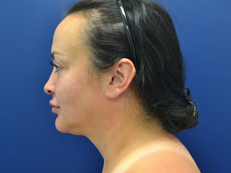 Neck Lift Before & After