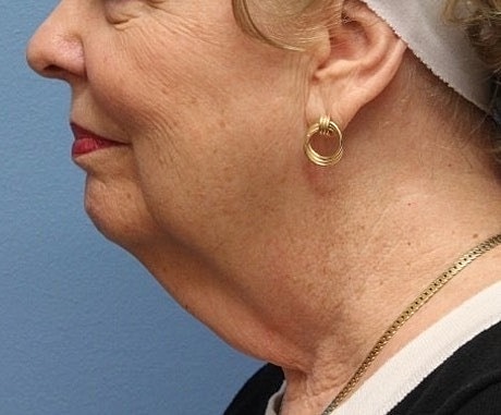 Neck Lift Before & After
