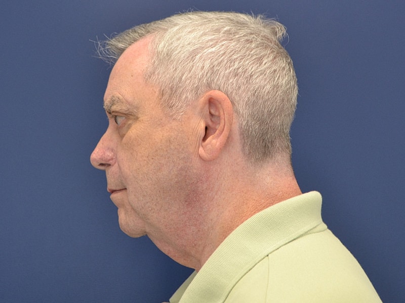 Neck Lift Before & After